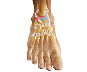 Ankle Impigmentation