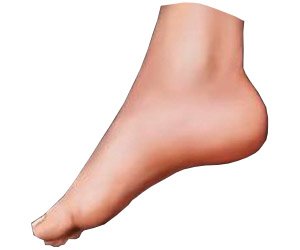 Foot Drop