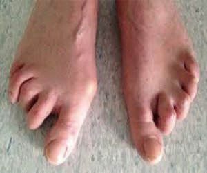 Claw Toe