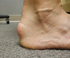 Haglund Deformity