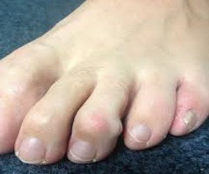 Mallet Toe