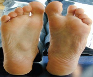 Plantar Fibromatosis